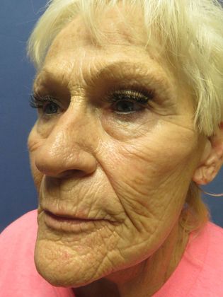 Laser Skin Resurfacing Case 1 - Before