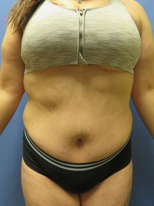 Abdominoplasty - Tummy Tuck: Case 32 - After