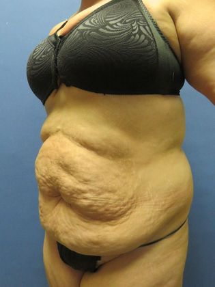 Abdominoplasty - Tummy Tuck: Case 32 - Before
