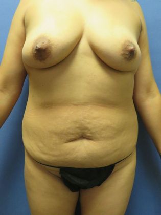 Mommy Makeover Case 10 - Before