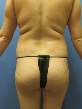 Brazilian Butt Lift Case 8 - Before