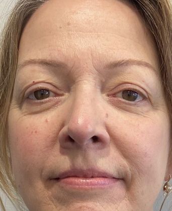 Eyelid Lift: Case 23 Eyelid Lift and Mini Browlift, Ridgefield, CT - Before
