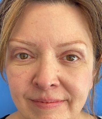 Eyelid Lift: Case 23 Eyelid Lift and Mini Browlift, Ridgefield, CT - After