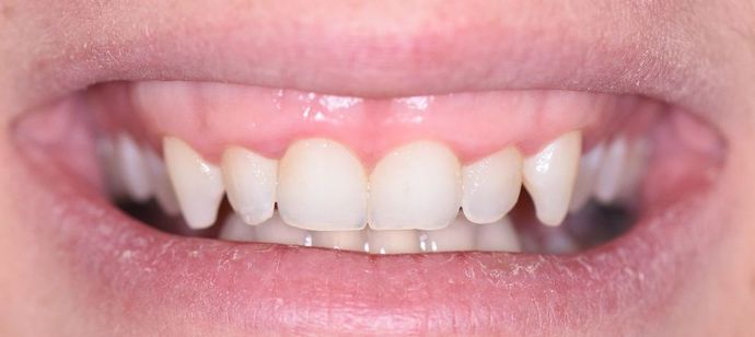 Tooth-colored Fillings Case 15 - Victoria, TX - Before