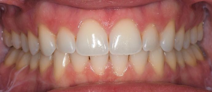 Invisalign: Case 1 - Inez, TX - Before