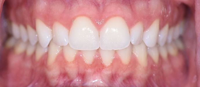 Invisalign: Case 1 - Inez, TX - After