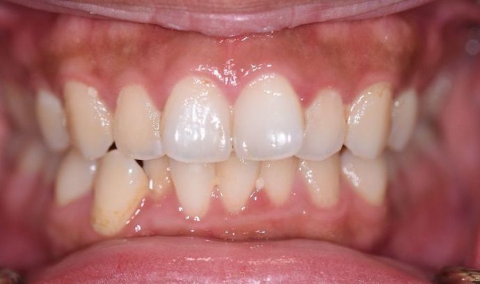 Invisalign Case 2 - Victoria, TX - Before