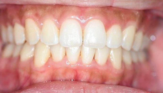 Invisalign Case 2 - Victoria, TX - After