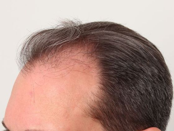 Male Before And After Hair Transplant Photos Hairline FUT (7) - Before