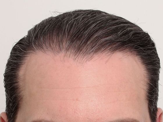 Hair Transplant - Male: Hairline FUT - Case 39 - After FUT hair transplant