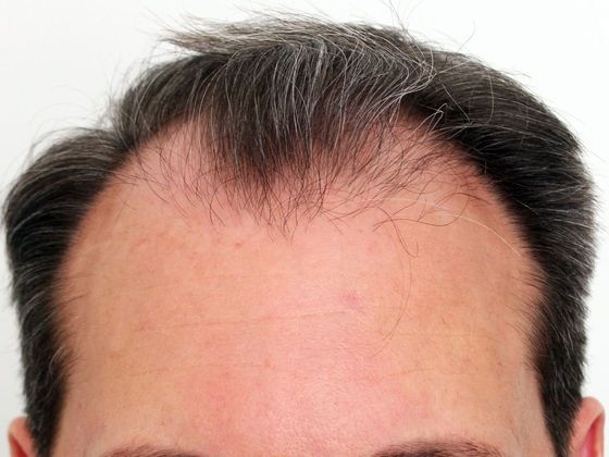 Hair Transplant - Male: Hairline FUT - Case 39 - Before FUT hair transplant