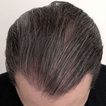Hair Transplant - Male: Hairline FUT - Case 39 - After FUT hair transplant