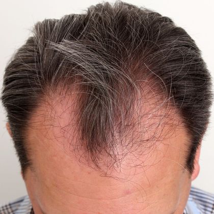 Hair Transplant - Male: Hairline FUT - Case 39 - Before FUT hair transplant
