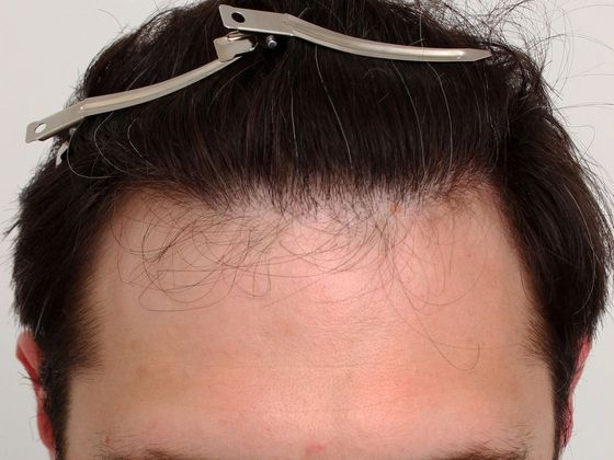 Male Before And After Hair Transplant Photos Front & Top (5) - After