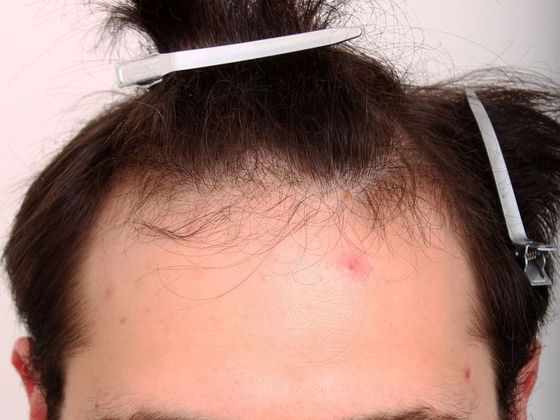 Male Before And After Hair Transplant Photos Front & Top (5) - Before