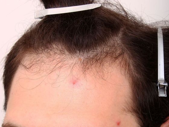 Hair Transplant - Male: Front & Top - Case 50 - Before FUT hair transplant