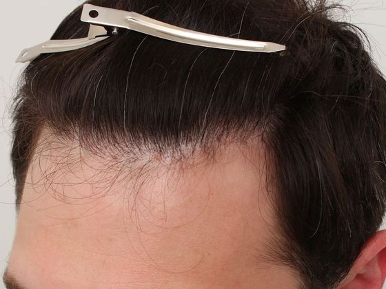 Hair Transplant - Male: Front & Top - Case 50 - After FUT hair transplant
