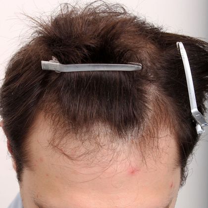 Hair Transplant - Male: Front & Top - Case 50 - Before FUT hair transplant