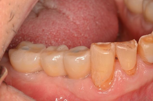 Bridges Case 7 - Before