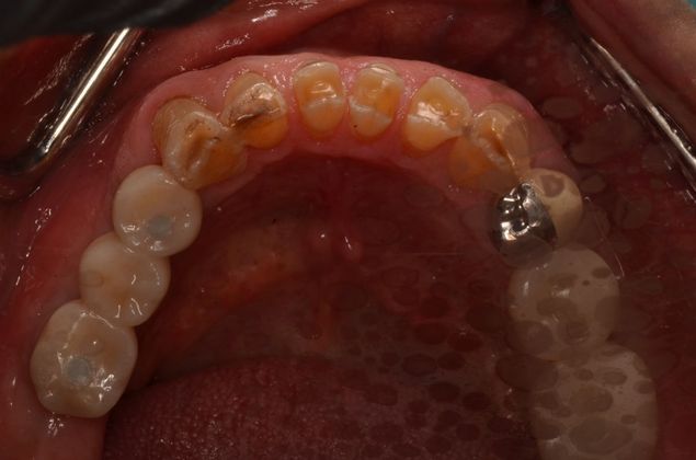 Bridges Case 7 - After