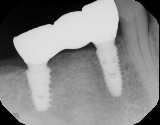 Bridges: Case 7 - Radiograph of implant supported brdige