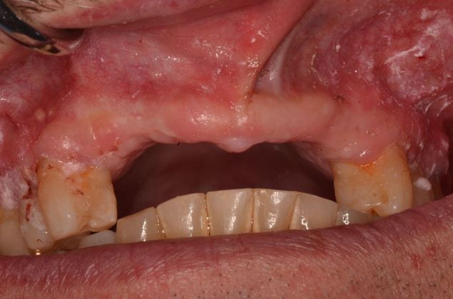 Bridges: Case 8 - Before implants and bridge