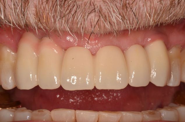 Bridges: Case 8 - After insertion of implant supported bridge on three implants