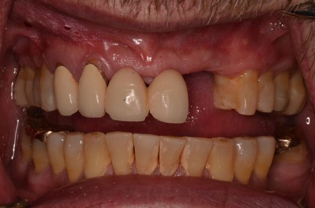 Bridges: Case 8 - Before with failing old bridge