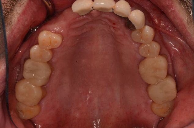 Bridges: Case 8 - Before with failing old bridge