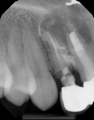 Dental Implants: Case 42 - Before radiograph of fractured and failing upper front teeth with abscess and infection