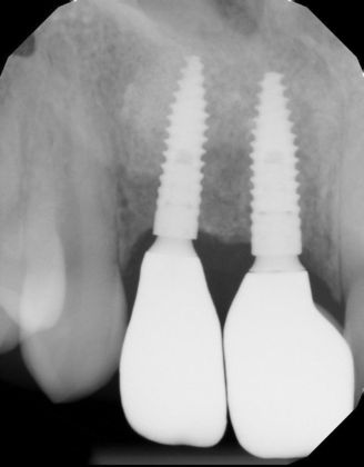Dental Implants: Case 42 - After implants and crowns