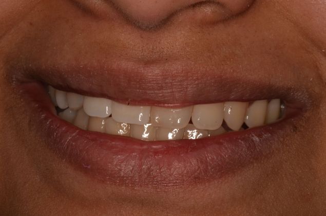 Dental Implants: Case 42 - Before