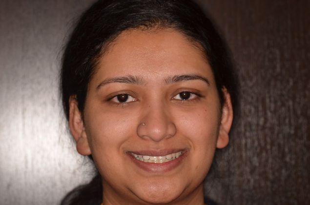 Dental Implants: Case 42 - After smile