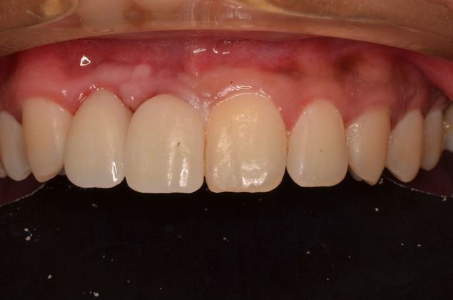 Dental Implants: Case 42 - After implants and crowns screwed into implants