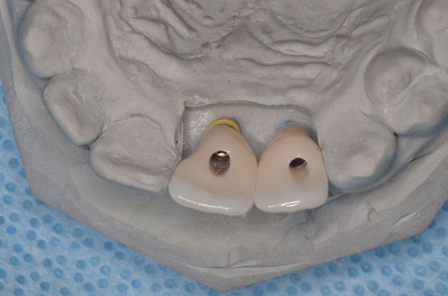 Dental Implants: Case 42 - Lab work of implant crowns