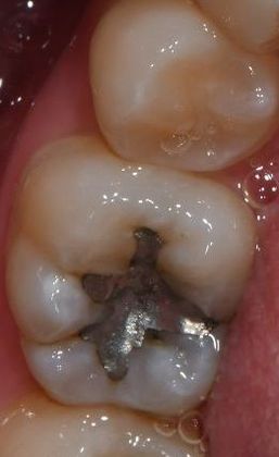 Tooth-colored Fillings Case 7 - Refugio, TX - Before