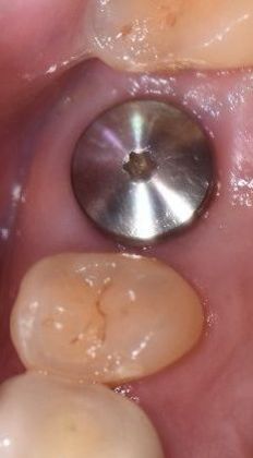Dental Implants Case 6 - Shiner, TX - Before