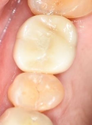 Dental Implants Case 6 - Shiner, TX - After