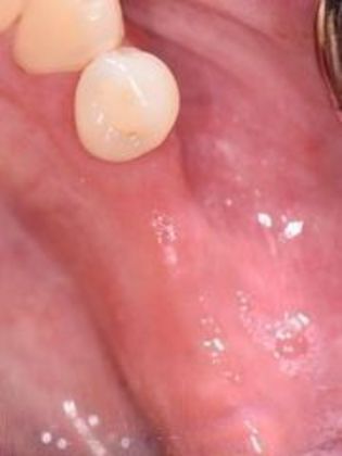 Dental Implants Case 7 - Goliad, TX - Before