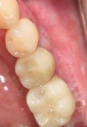 Dental Implants Case 7 - Goliad, TX - After