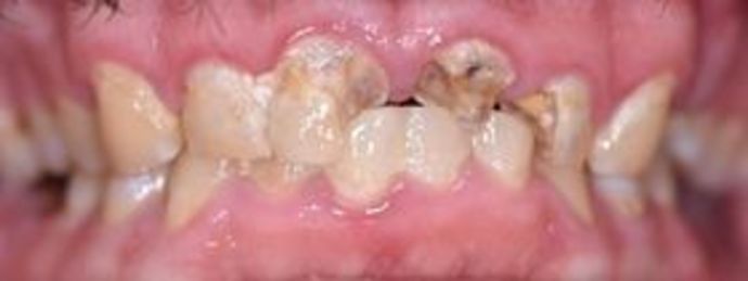 Tooth-colored Fillings Case 11 - Inez, TX - Before