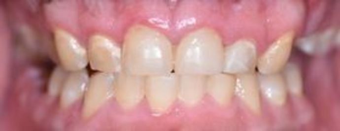 Tooth-colored Fillings Case 11 - Inez, TX - After