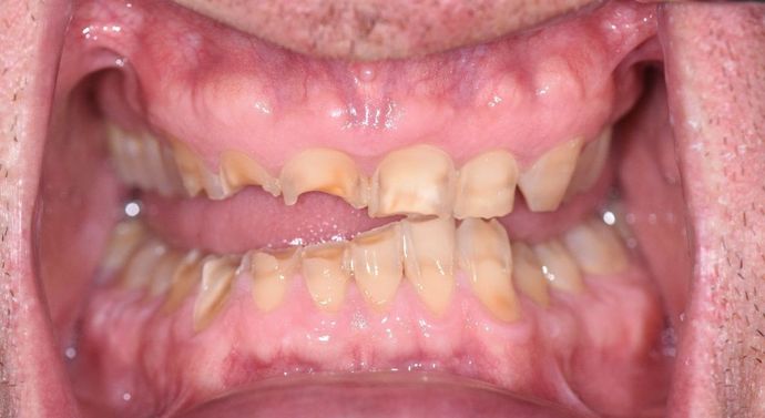 Full Mouth Reconstruction Case 2 - Cuero, TX - Before