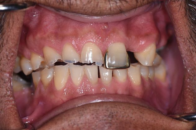 Full Mouth Reconstruction Case 3 - Port Lavaca, TX - Before