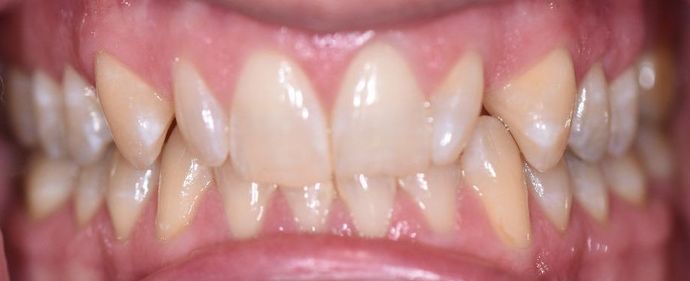 Invisalign Case 3 - Cuero, TX - Before