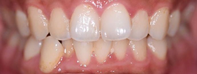 Invisalign Case 4 - Halletsville, TX - Before