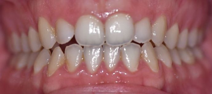 Invisalign: Case 5 - Shiner, TX - Before 1147
