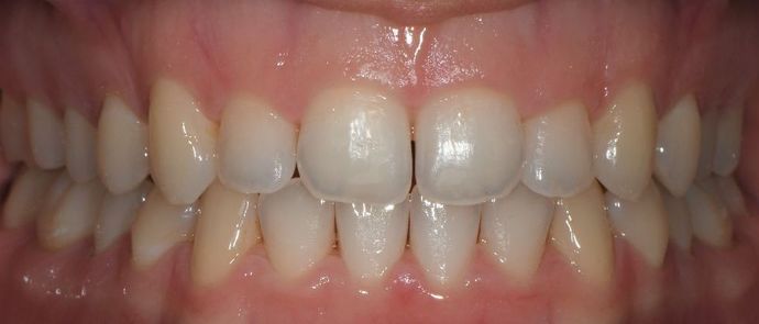 Invisalign: Case 5 - Shiner, TX - After