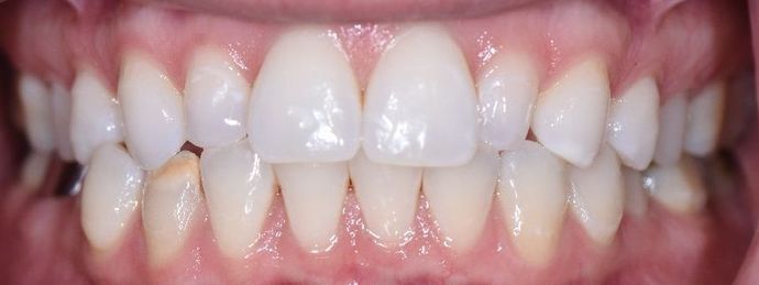 Invisalign Case 6 - Goliad, TX - Before