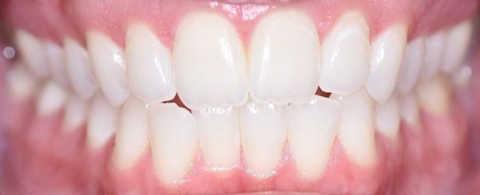 Invisalign: Case 7 - Corpus Christi, TX - Before 13